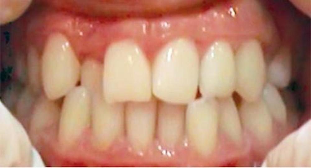 What Are the Reasons Behind Crooked Teeth?