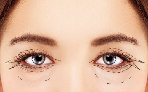 Choosing The Right Surgeon For Your Eyelid Surgery